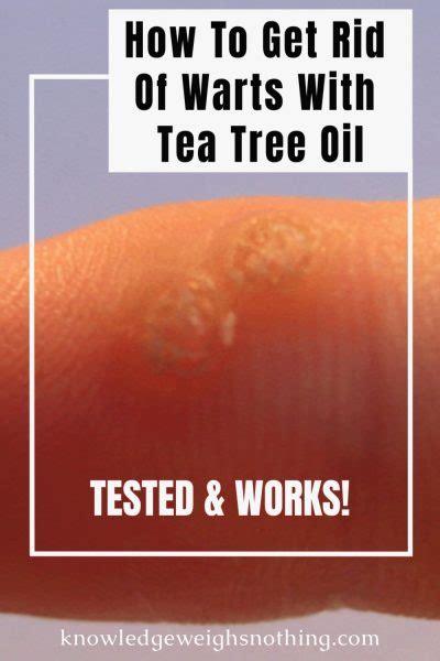 How To Get Rid Of Warts With Tea Tree Oil Tested And Works