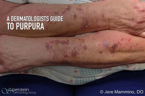 Understanding Purpura Begins With A Professional Dermatologist