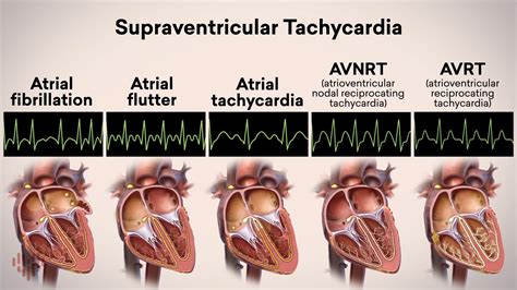 Atrial Flutter