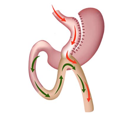 Mini Gastric Bypass