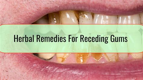 Herbal Remedies For Receding Gums • Health blog