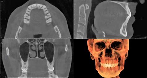 CBCT What Is It And How Does It Work Radiodontics