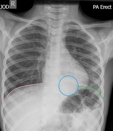 Left Lobar Pneumonia X Ray