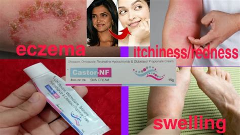 Castor Nf Cream Skin Cream For All Fungal Infections Uses Benefits Or Side Effects Youtube