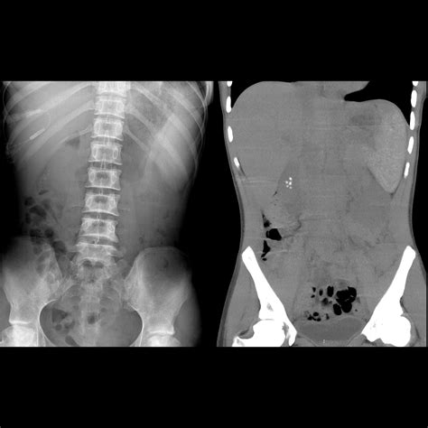 Teenager With Sickle Cell Disease And Abdominal Pain Pediatric