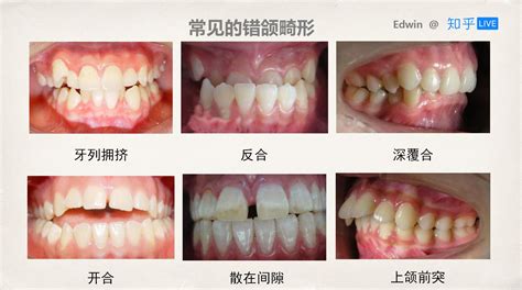 保护牙齿，一辈子你需要做好这些事 知乎