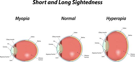 Myopia And Your Eyes: Near-Sightedness Debunked - Global Health Blog