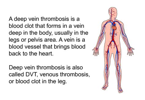 Preventing Deep Vein Thrombosis