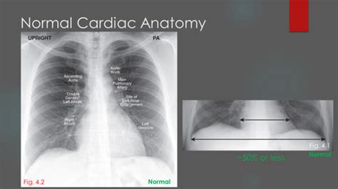 DM Cardiac Chest X Ray Flashcards Quizlet