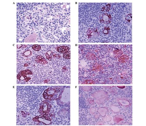 Intercellular Adhesion Molecule 1 Is A Sensitive And Diagnostically