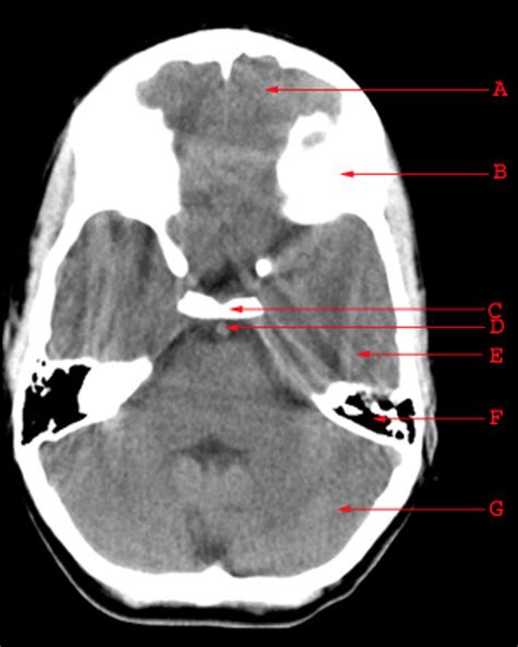 CT Head Anatomy Part 2 Diagram | Quizlet