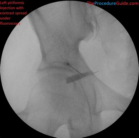 Piriformis Injection Landmarks