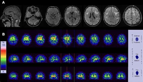 Structural And Functional Brain Imaging Of Case Brain Sagittal And