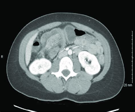 Abdominalpelvic Ct Showing Colocolonic Intussusception At The Hepatic Download Scientific