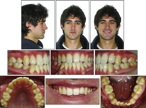 Pretreatment Facial And Intraoral Photographs Facial Photographs Show