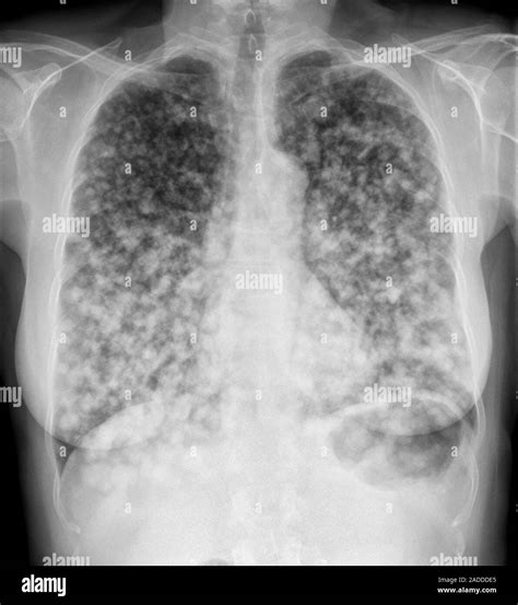 le cancer du poumon secondaire radiographie dune section par les