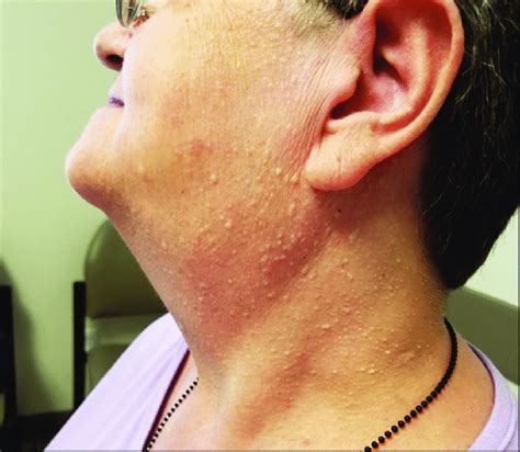 Face And Neck Showing Multiple Dome Shaped Flesh Colored Skin Papules