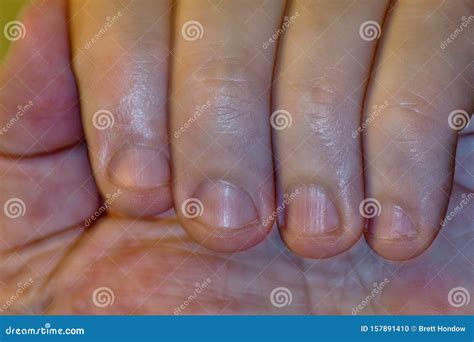 Nail Biting Habit As Seen Up Close. Stock Photo - Image of color ...