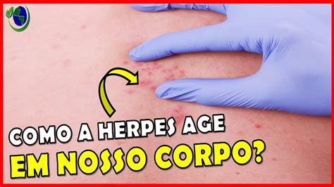 Entenda Quem O V Rus Herpes Zoster Como Ele Age Em Nosso Organismo