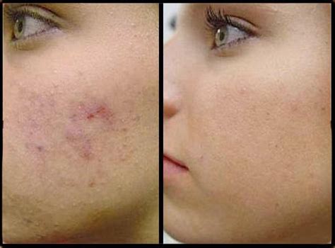 "Сотрет": отзывы о препарате и инструкция по применению