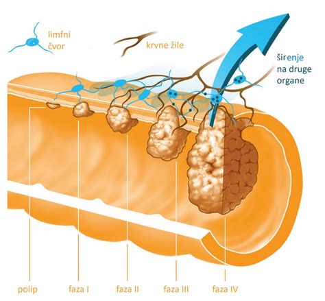 Rak Debelog Crijeva Simptomi Uzroci I Lije Enje Telegram Hr