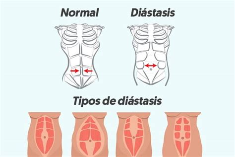 Qu Es La Di Stasis Abdominal S Ntomas Y Tratamiento Con Fotos Reales