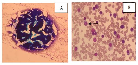 The bone marrow aspirate fragments (A) showed hypercellular fragments ...