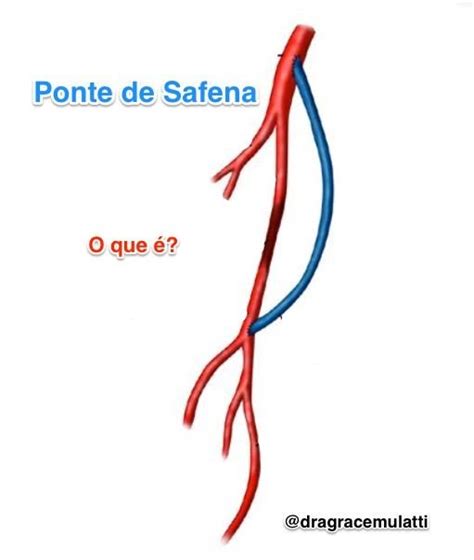 Ponte De Safena Cl Nica Mulatti Cl Nica Especializada Em Cirurgia