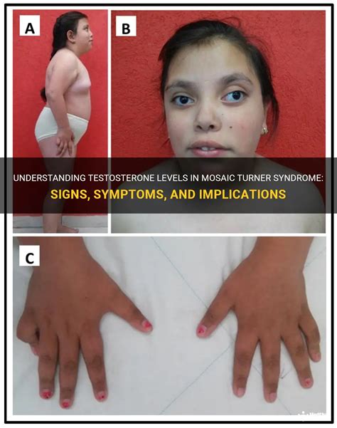 Understanding Testosterone Levels In Mosaic Turner Syndrome Signs