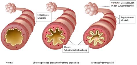 Kinderarzt Dr Med Florian Palm Berreagierende Bronchien Im