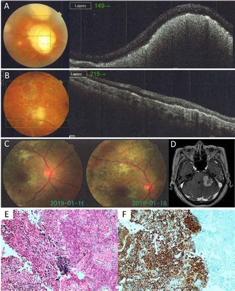 Scielo Brasil Primary Intraocular Lymphoma Case Report And Proposed Diagnostic Algorithm