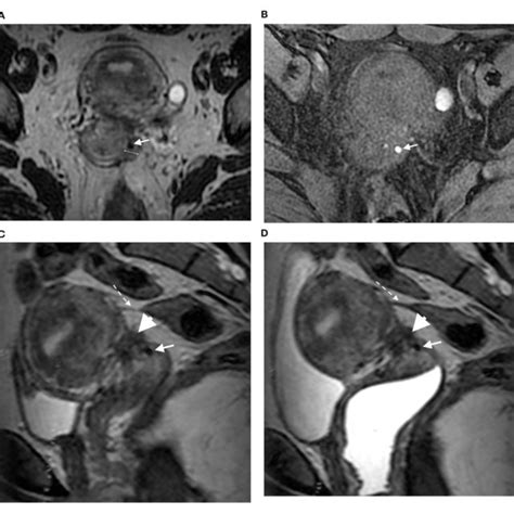 Axial 3dt2 A And 3dt1fs B Mr Images In 40 Year Old Woman Show Download Scientific Diagram