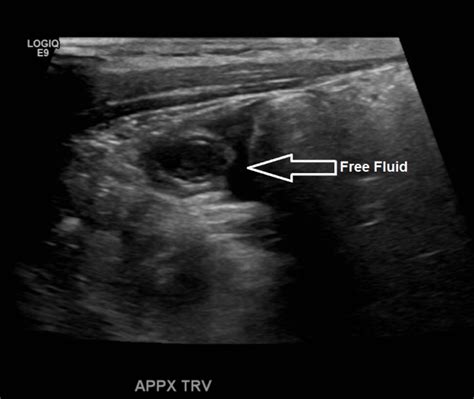 Appendix Ultrasound – Sonographic Tendencies