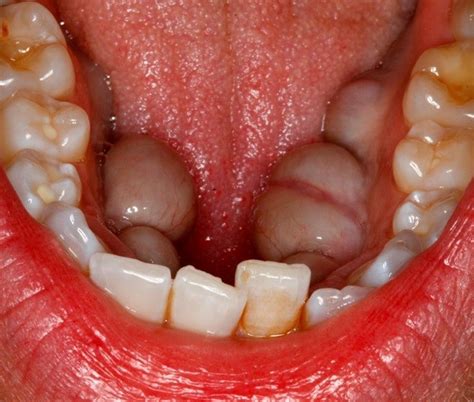 Oral Pathology What Are Mandibular Tori Directorio Odontol Gico