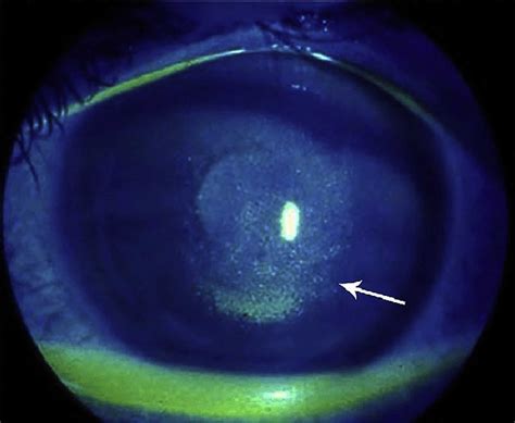 Keratoconjunctivitis sicca, causes, symptoms, diagnosis, treatment ...