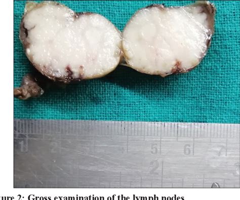 Figure 2 From A CASE REPORT ON UNICENTRIC FORM OF CASTLEMANS DISEASE