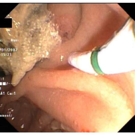 Endoscopic Retrograde Cholangiopancreatography ERCP Images