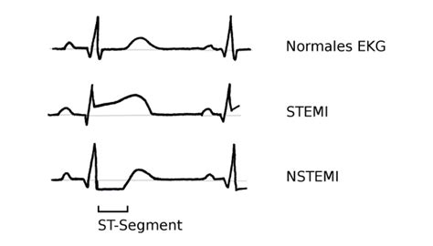 Stemi Vs Nstemi Ekg