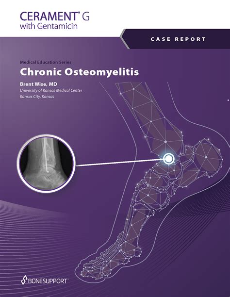 Chronic Osteomyelitis Of The Distal Tibia Brent Wise MD University Of