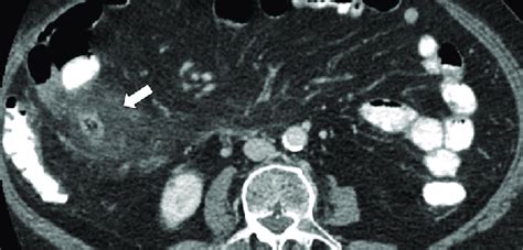 Fat Stranding Or Thickening Of The Para Renal Or Latero Conal Fascia