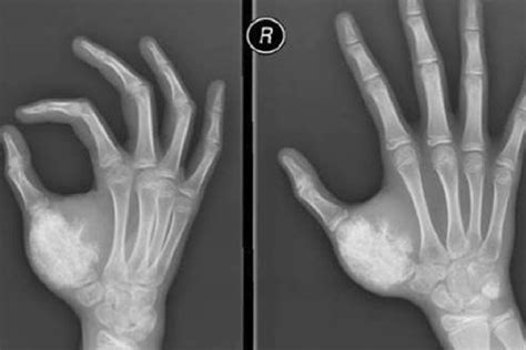 Unveiling Breakthroughs in Ewing Sarcoma Cancer Treatment