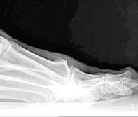 Fusion of the Metatarsal Phalangeal Joint with BMA & Bone Autograft (case report) | Aspire ...