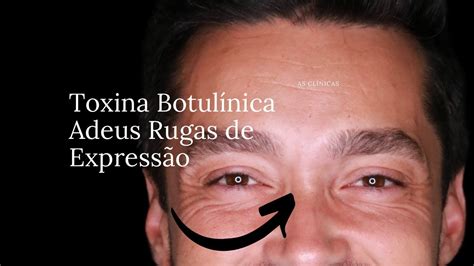 Rugas De Express O Toxina Botul Nica Em Homens Procedimento Passo A