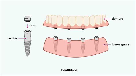 How much do dental implants cost without insurance? - Dental News Network