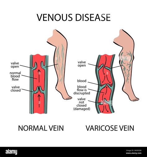 Varicosities Diagram