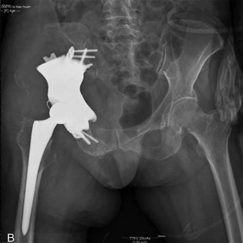 Postoperative Follow Up Pelvic X Ray Image A Intraoperative X Ray Download Scientific