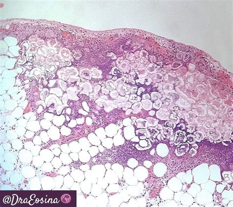 Saponification Histology