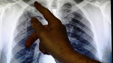 Tuberculosis Can Cause Severe Damage To The Lungs Leaving Patients