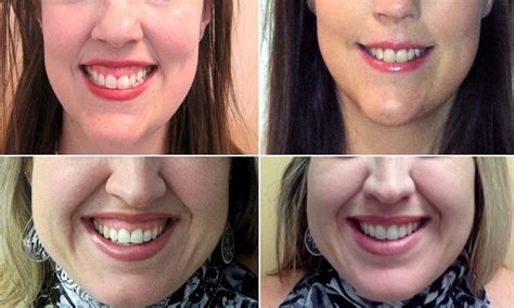 The Secret To A Hollywood Smile Botox Injections Fix Gummy Grins Botox Injections Botox