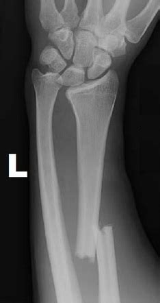 Galeazzi fracture-dislocation | Radiology Case | Radiopaedia.org